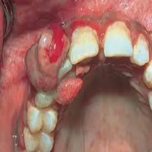 Nadziąślak ropotwórczy