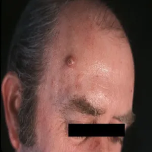 Narośl guzek na czole rogowiak kolczystokomórkowy 