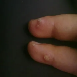 Narośl na palcach kurzajki