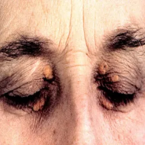 Narośl w kąciku oka żółtaki 