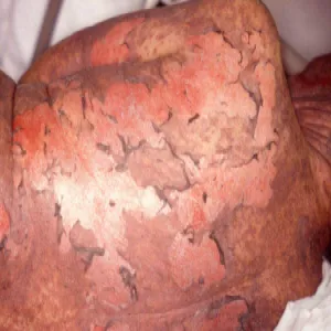 Nekroliza naskórka zdjęcia