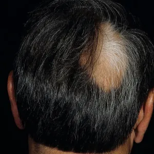 Nerwica wypadanie włosów łysienie plackowate 