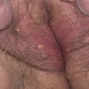 Niebolący guzek na wargach sromowych