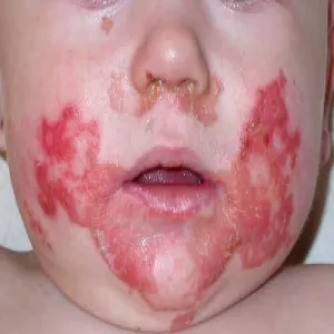 Niedobór cynku u dzieci zespół Danbolta-Clossa