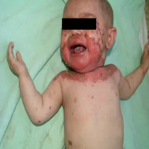 Niedobór cynku u niemowląt zespół Brandta