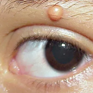 Nieduży guzek nad okiem żółtakoziarniniakowatość młodzieńcza 