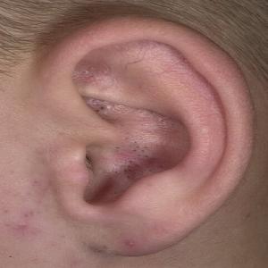 Nieestetyczne czarne kropki w uchu zaskórniki otwarte