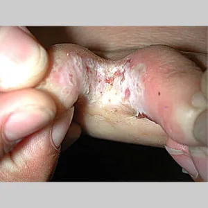 Niegojącą się rana między palcami stopa sportowca 