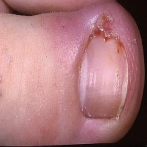 Niegojącą się rana przy paznokciu