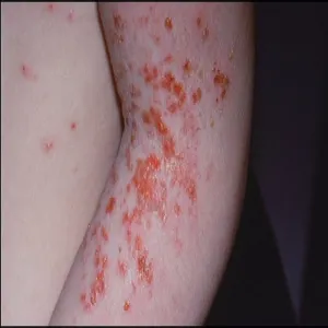 Nieswędząca wysypka u dziecka liszajec zakaźny