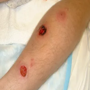 Niesztowica bakteryjna