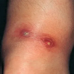 Niesztowica gronkowiec złocisty 