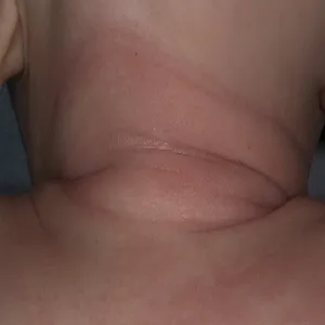 Objawy atopowego atopowe zapalenie skóry u niemowląt