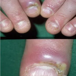 Obrzęk zaczerwienienie wyrostka okołopaznokciowego