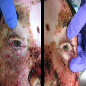 Oczy choroba zespół Stevensa- Johnsona 