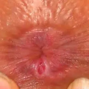 Odbytnica choroby szczelina odbytu 