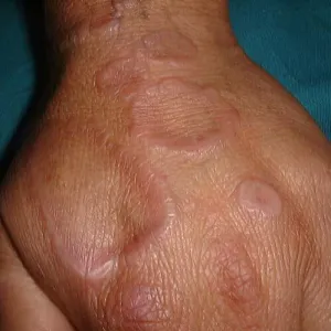 Okrągłe czerwone plamy na dłoniach ziarniniak obrączkowaty 