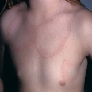 Okrągłe plamy na klatce piersiowej ziarniniak obrączkowaty 