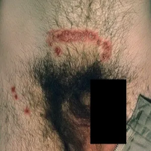 Opryszczka miejsc intymnych