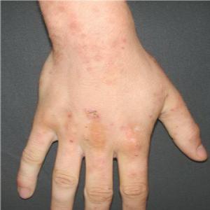 Opryszczkowate zapalenie skóry na dłoniach