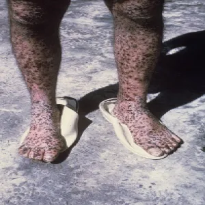 Ospa prawdziwa zdjęcie