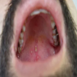 Ospa wietrzna jama ustna