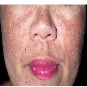 Ostuda nad górną wargą