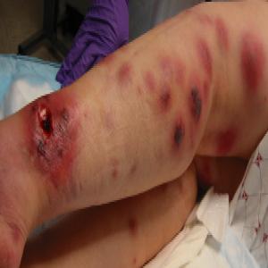 Otwierające się rany na nogach piodermia zgorzelinowa