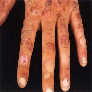 Pęcherze na palcach dłoni porfiria skórna późna 