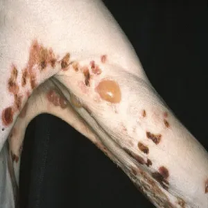 Pęcherze na rękach pemfigoid pęcherzowy