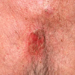 Pęcherzyca miejsc intymnych