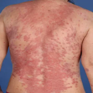 Pęcherzyca zwykła na plecach