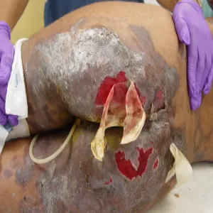 Pęcherzyca zwykła na pośladkach