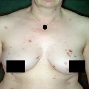 Pęcherzyca zwykła u kobiet