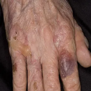Pęcherzyki na dłoniach pemfigoid pęcherzowy