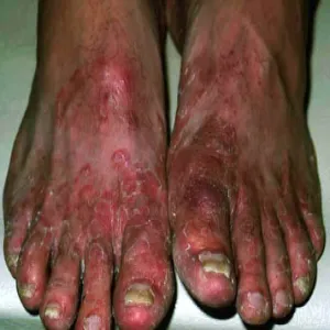 Pęcherzyki z płynem surowiczym stopa sportowca 