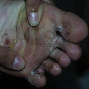 Pękająca skóra pod palcami u nóg stopa sportowca 