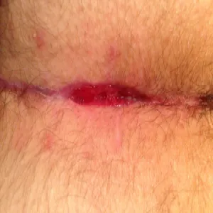 Pęknięta skóra między pośladkami