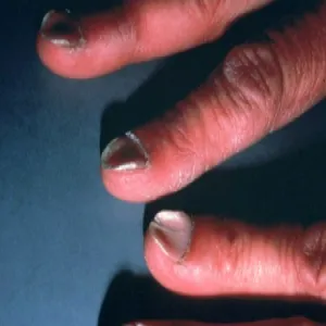 Paznokcie rurkowate koilonychia