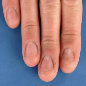 Paznokcie u rąk choroby liszaj płaski