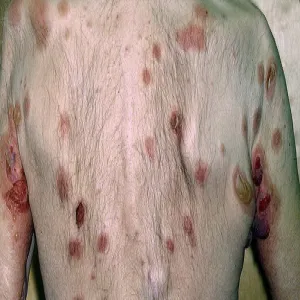 Pemphogoid Bullosus