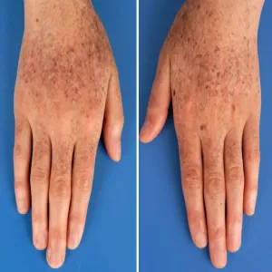 Pergaminowa skóra dłoni