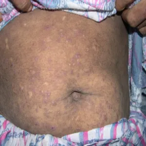 Pergaminowa skóra na brzuchu