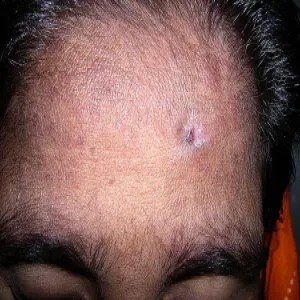 Pergaminowa skóra u starszych