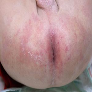 Pieluszkowe zapalenie skóry u noworodków