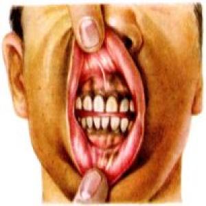 Pigmentacja błony śluzowej jamy ustnej 