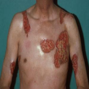 Piodermia zgorzelinowa w chorobie Crohna