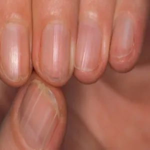 Pionowa biała kreska na paznokciu