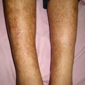 Plamica barwnikowa choroba Schamberga