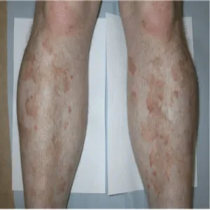 Plamy na nogach u mężczyzn 